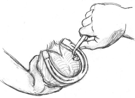 Removing Stone, (c) Jock Dempsey